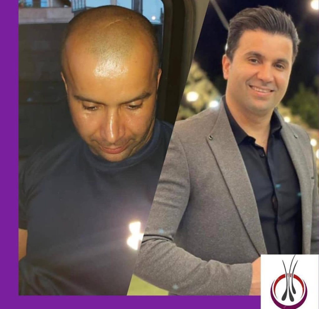 کاشت مو اسدی در ساری