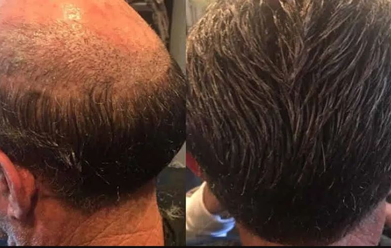 مشاوره تخصصی قبل از کاشت